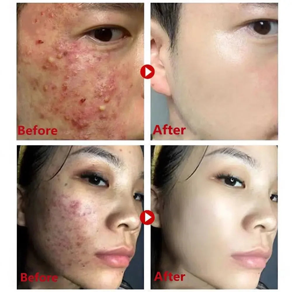 Green Tea Mask Stick – Blackhead & Acne Removal, Deep Cleansing